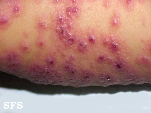 Eczema herpeticum. Adapted from Dermatology Atlas.[1]