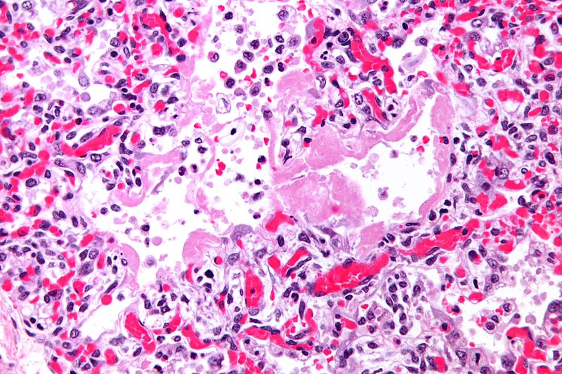 Micrograph of hyaline membranes, as seen in diffuse alveolar damage (DAD), the histologic correlate of adult respiratory distress syndrome (ARDS).