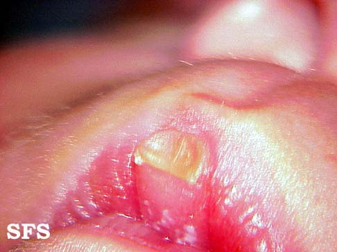 Lip callosity. Adapted from Dermatology Atlas.[1]