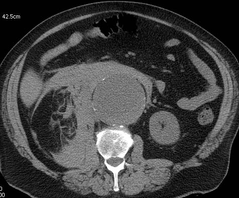 This patient presented with acute abdominal pain and hypotension. His non-contrast CT shows a large AAA and extensive periaortic haematoma. A thick (but subtle) hyperdense crescent is present within the aortic wall posteriorly and laterally which represents acute intramural hematoma, a sign of acute or impending rupture. (Image courtesy of Dr Donna D'Souza)