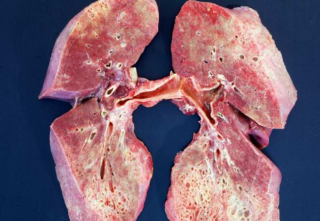 File:Scleroderma lung 1.jpg