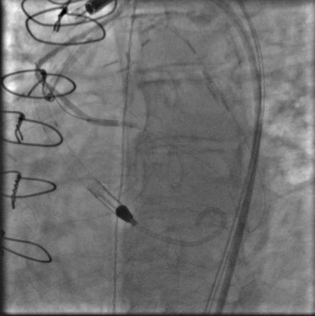 Figure 4. : Inflating a 3.5mm balloon in the left main CTO to create a channel for antegrade access. The guide in the ascending aorta will not engage the left main despite repeated efforts from a radial approach.