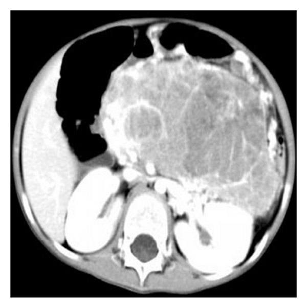 Contrast-enhanced CT revealed the heterogeneous mass with obvious enhancement areas and scattered low attenuation.[4]