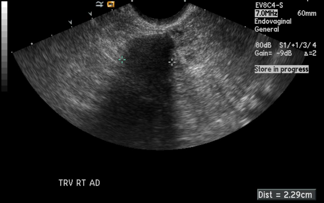 US: Ovarian fibroma.