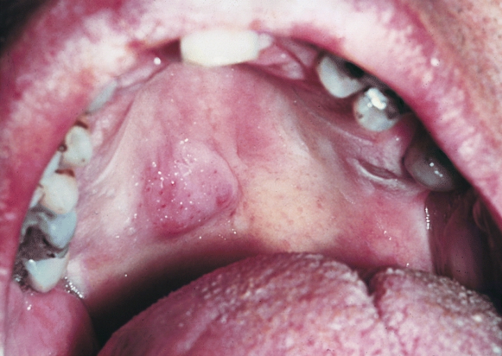 SALIVARY GLANDS: NECROTIZING SIALOMETAPLASIA. Swelling, as shown in this photograph of a palatal lesion, is a frequent initial clinical presentation. Many of the swellings subsequently ulcerate. (Courtesy of Dr. Ralph Correll, LosAngeles, CA.)