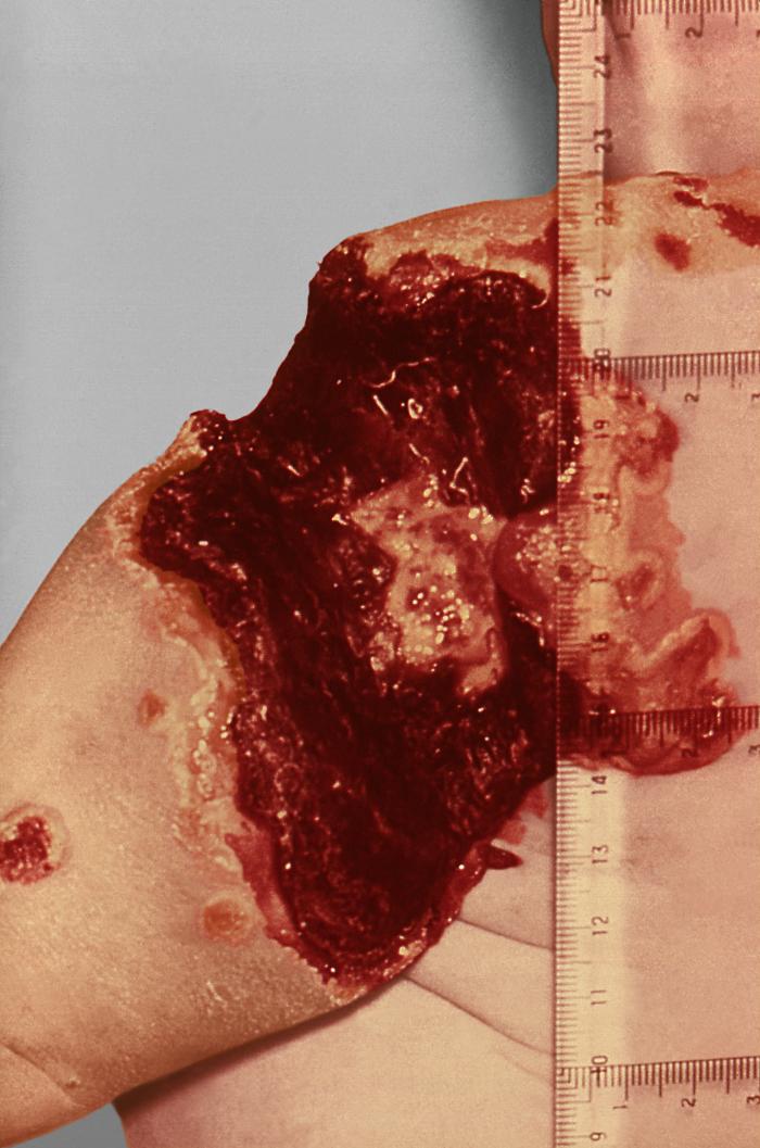 Left arm and shoulder area of child with deficient cellular immunity, who had sustained the ravages of vaccinia necrosum, after having received a smallpox vaccination 4 month earlier. Note massive necrosis and destruction of tissue caused by this condition.Adapted from Public Health Image Library (PHIL), Centers for Disease Control and Prevention.[3]
