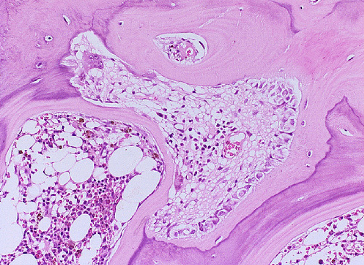 File:Renal osteodystrophy microscopic pathology.jpg