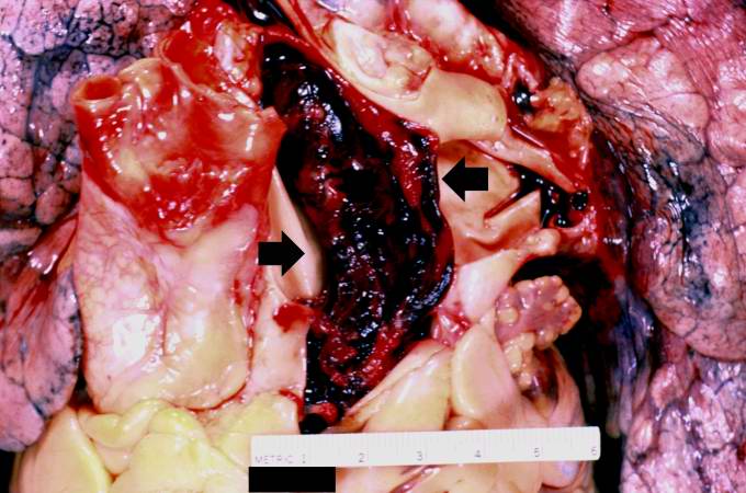 This is a gross photograph of the heart with the main pulmonary artery opened. Note the thromboembolus filling the pulmonary artery (arrows).