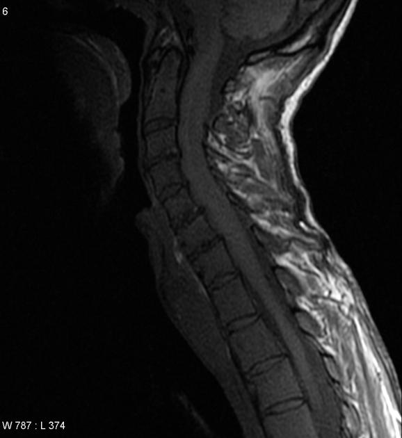 Sagittal spinal T1 weighted MRI image illustrating heterogeneous and diffuse enhancement of chronic lymphocytic leukemia. [1]