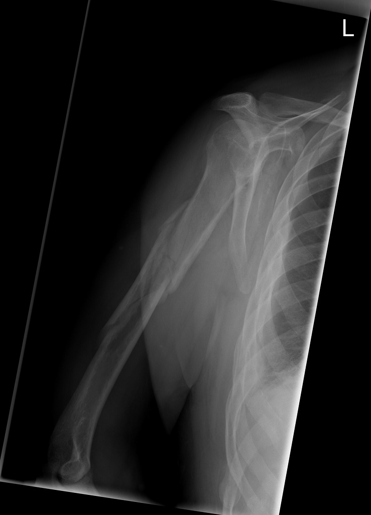 Humeral shaft fracture with displacement of fragments and a "butterfly fragment".