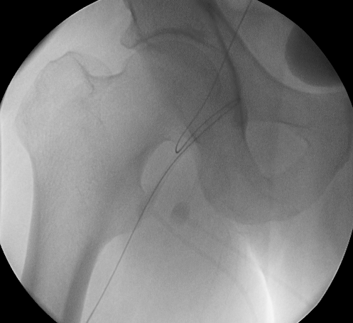Complication during right femoral artery puncture. Image courtesy of C. Michael Gibson and copylefted.