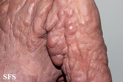 File:Mycosis fungoides 16.jpg