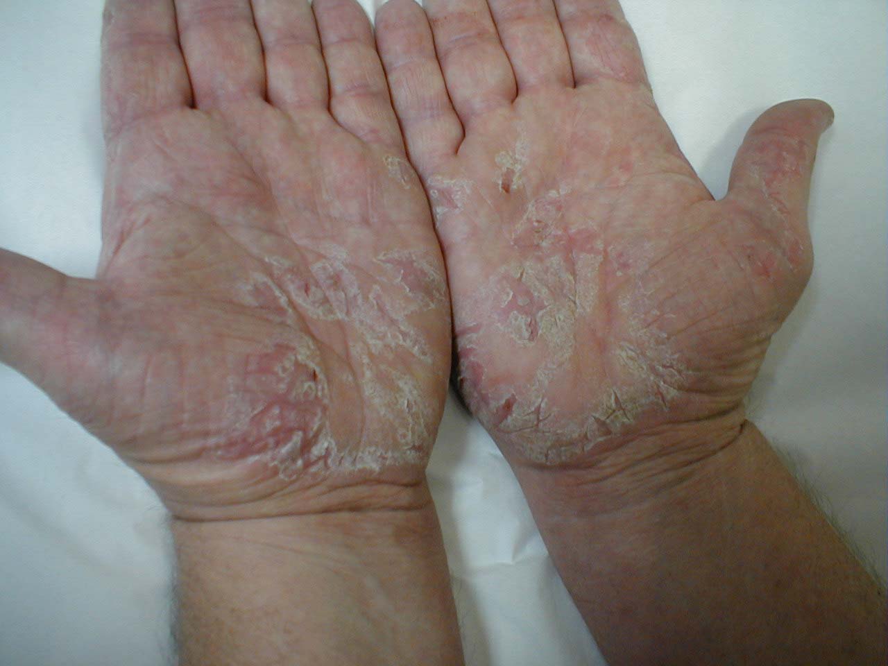 File:Skin atopic dermatitis.jpg