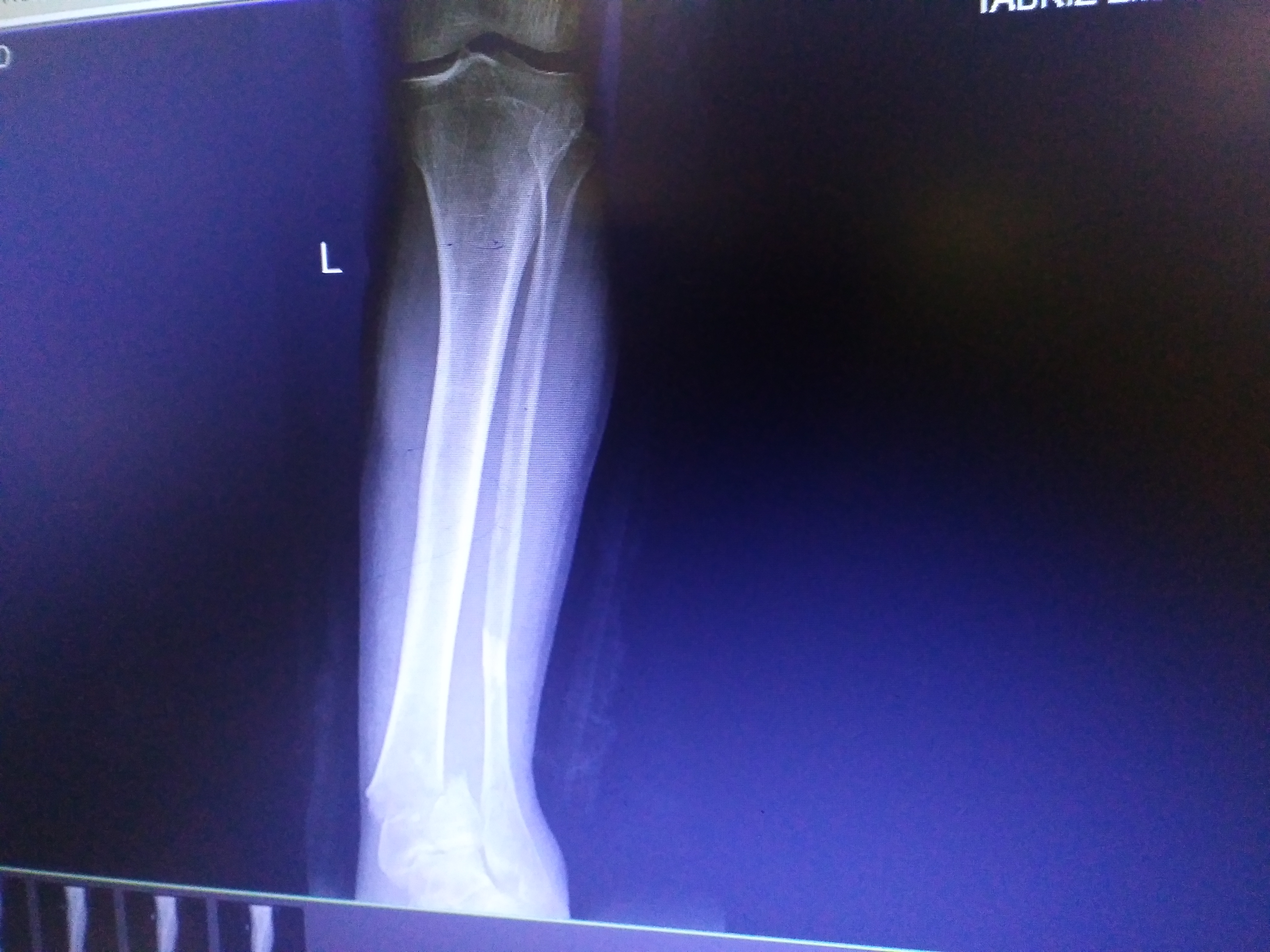There is a comminuted distal tibial fracture extending into the tibial plafond.