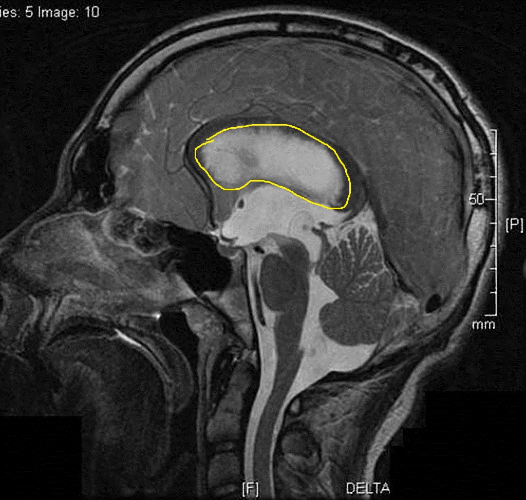 File:Intraventricular-neurocysticercosis-resulting-in-acute-hydrocephalus (1).jpg
