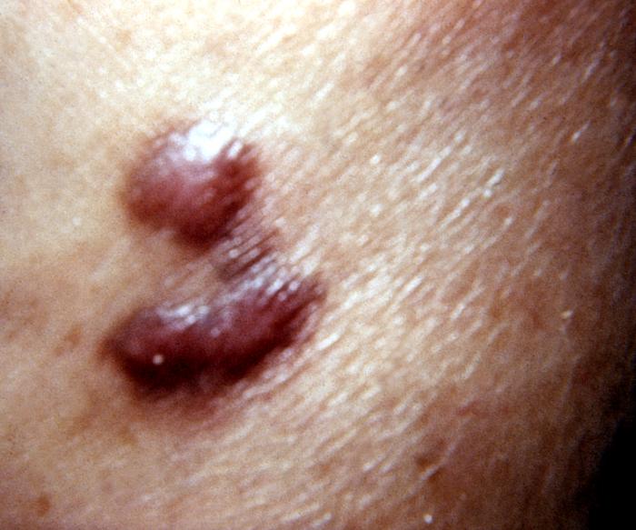 Kaposi's sarcoma lesion commonly found in patients with stage IV AIDS