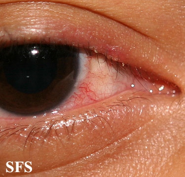 Opthalmic rosacea. Adapted from Dermatology Atlas.[3]