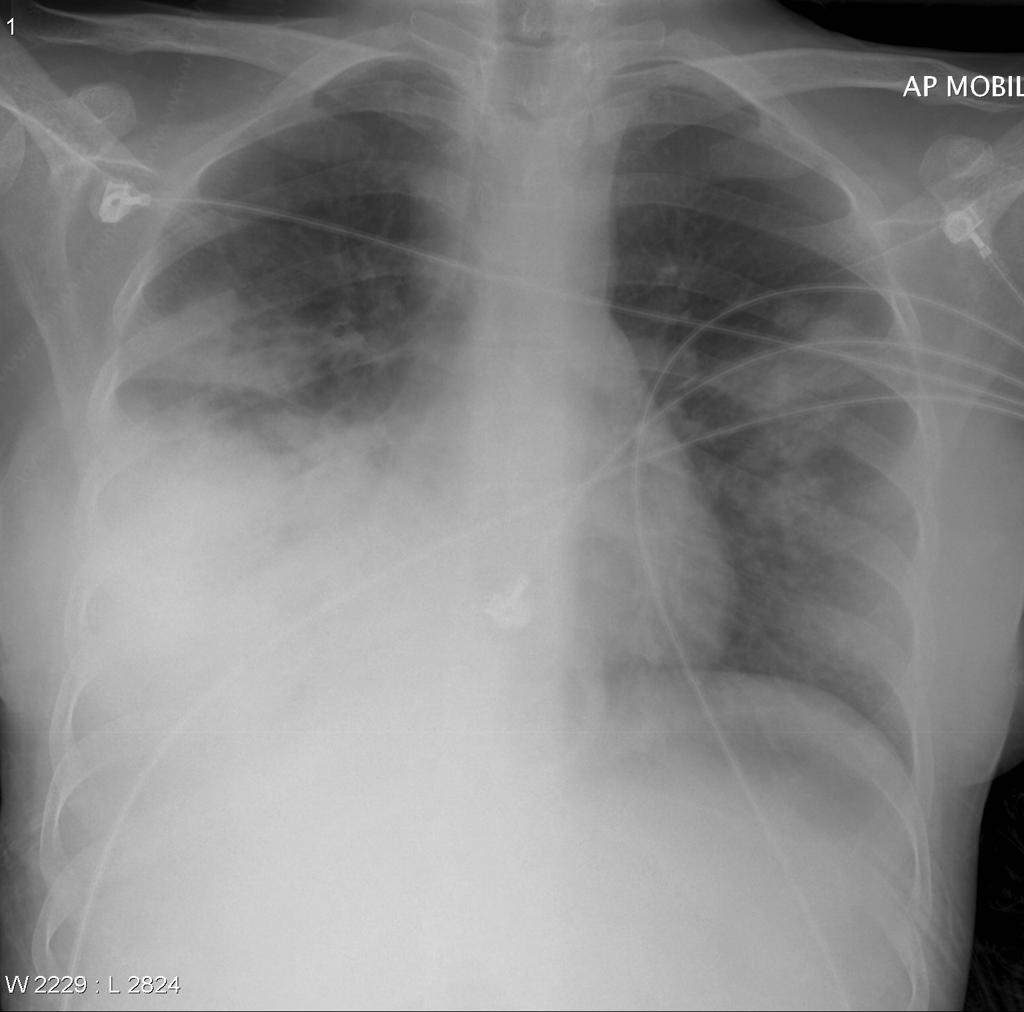 File:Pneumococcal Pneumonia Chest Xray..jpg