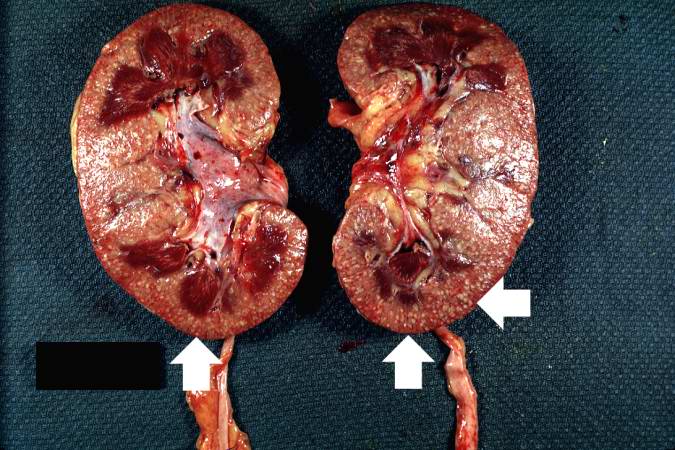This photograph of the cut surface of these kidneys shows that these multifocal punctate lesions are primarily in the cortex (arrows).