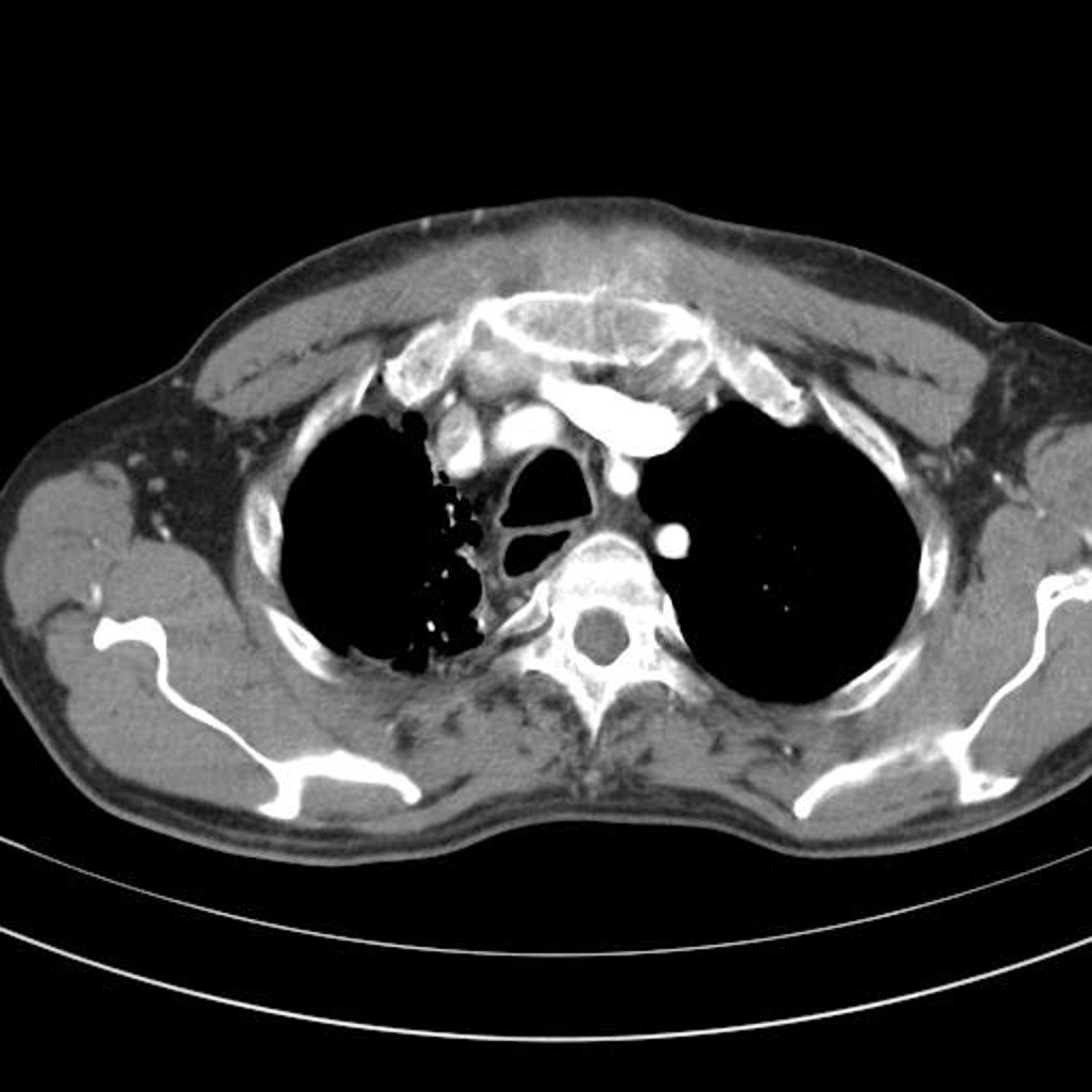 File:Sternal-osteosarcoma (1).jpg