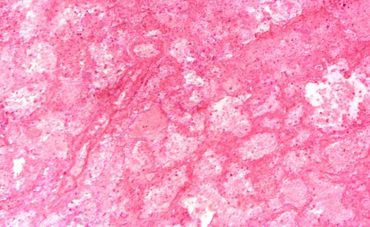 This is a low-power photomicrograph of the infarcted lung. The tissue is congested and has a very bland appearance due to coagulation necrosis of the lung parenchyma. You can still see the outlines of the alveoli and the cells that make-up the alveoli but there is almost complete loss of nuclei throughout this section.