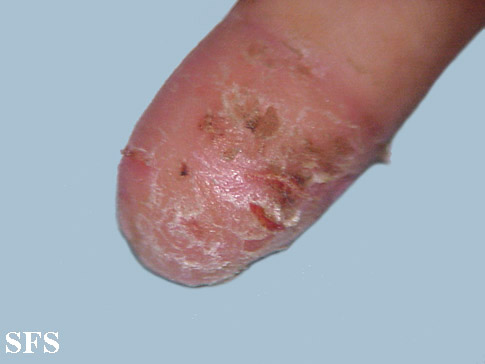Acrodermatitis continua. [http://atlasdermatologico.com.br/disease.jsf?diseaseId=11