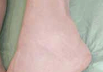 Tenosynovitis in ankle