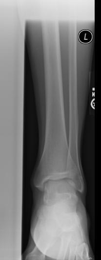 Normal ankle; AP