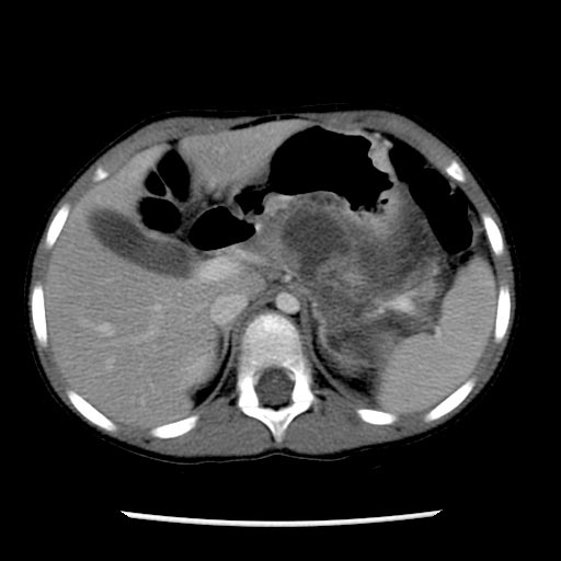 Computed Tomography, Pancreatic laceration: A patient with pancreatic transection and pseudocyst formation from motor vehicle accident