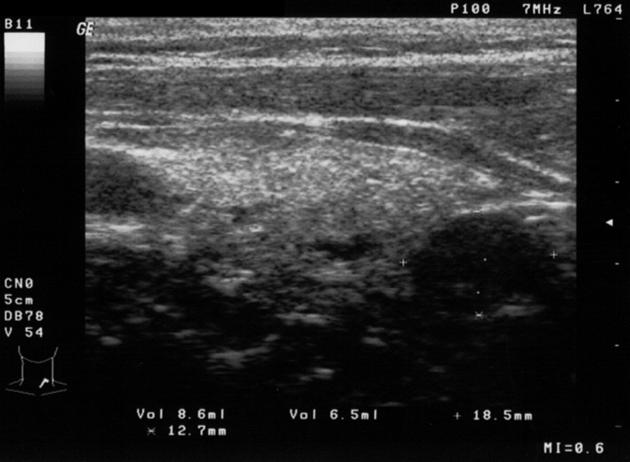 Sharply marginated, hypoechogenic lesion at the dorsal lower pole of the left thyroid lobe.<ref name=radio>Image courtesy of Dr Roberto Schubert. Radiopaedia (original file ‘’here’’). 