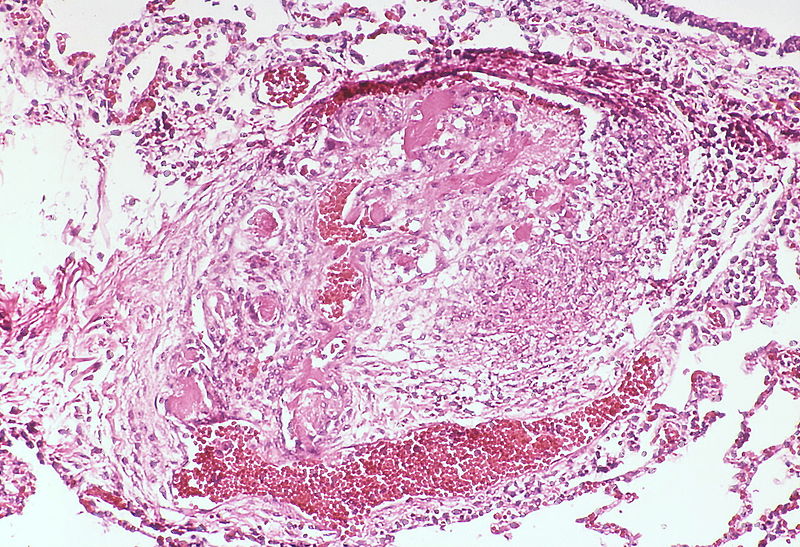This angiomatoid lesion contains multiple thrombi within the vascular spaces. A large dilatation lesion is present adjacent to the bottomof the angiomatoid lesion.