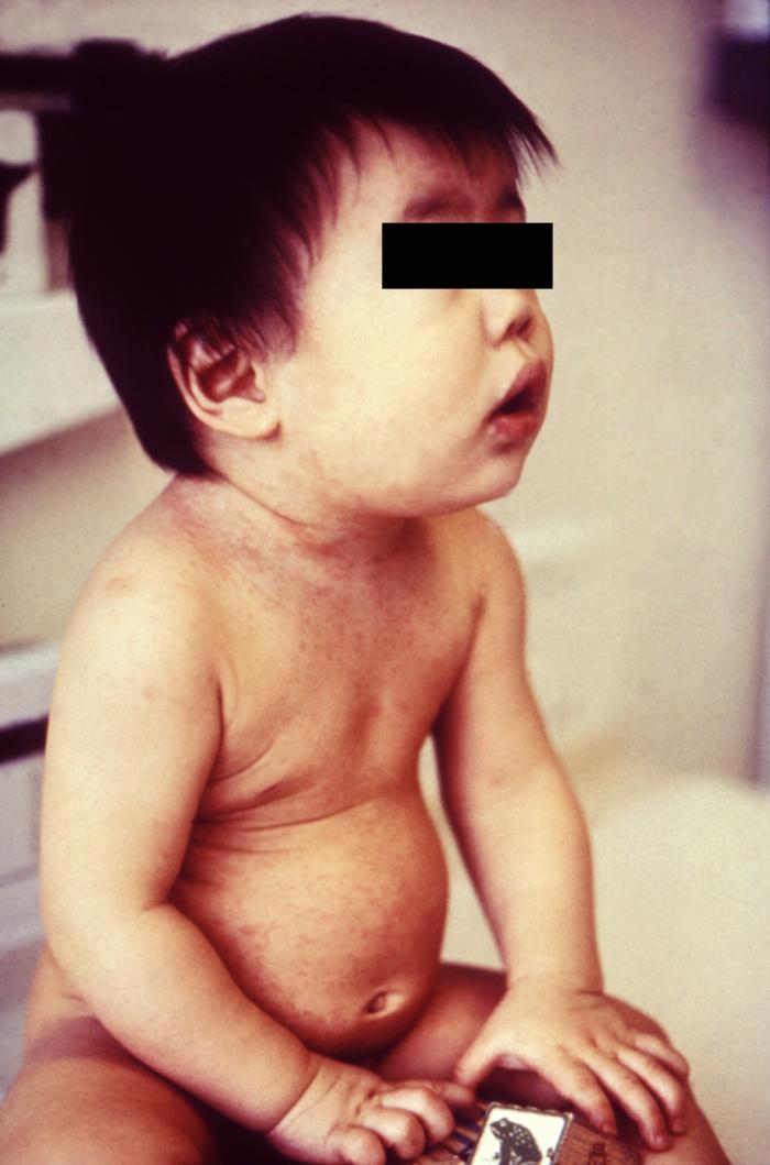 This is an 11 mo. old infant with a mild rubella rash, as well as a nondescript secondary macular eruption. - Source: https://www.cdc.gov/