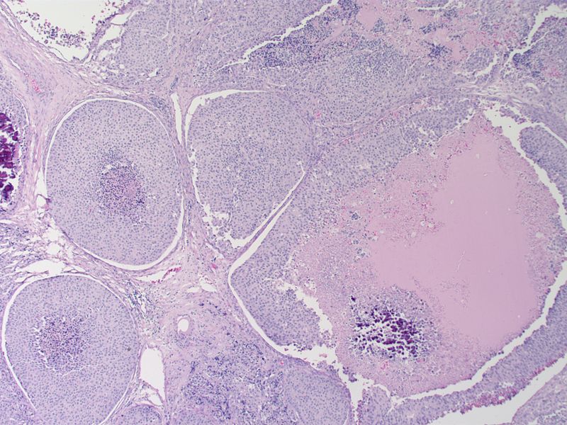 Medullary thyroid carcinoma comedonecrosis