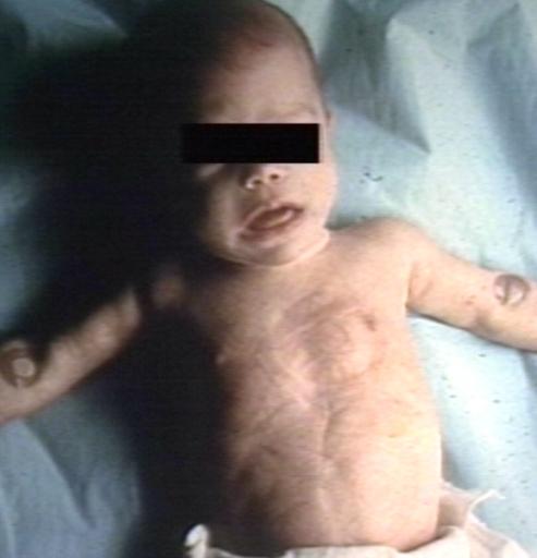 Pompe's Disease, Glycogen Storage Disease Type II. Child in crib