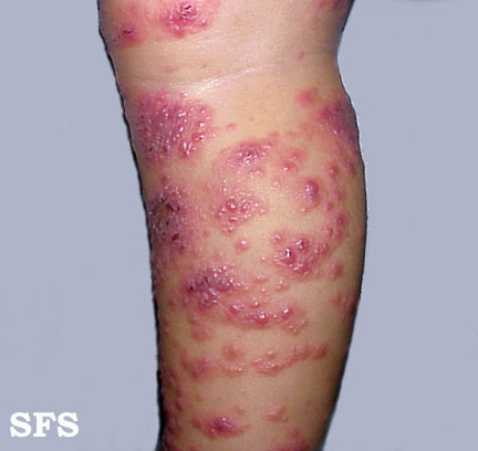 File:Eczema herpeticum03.jpg