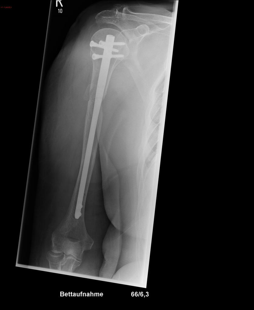 Humerus fracture after osteosynthesis