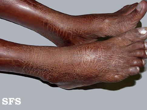 Acquired Ichthyosis-Clofazimine. Adapted from Dermatology Atlas.[3]