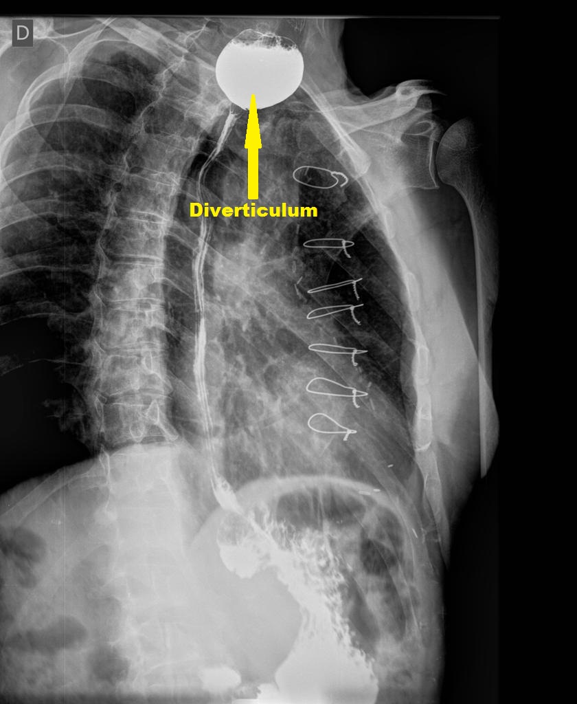 Barium swallow graphy: Zenker's diverticulum-Oblique view Source:Radiopaedia[2]
