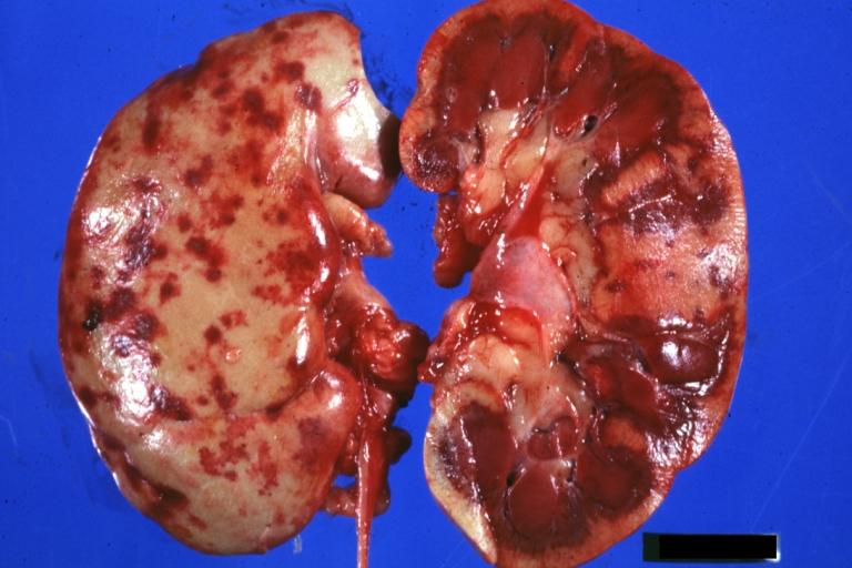 Kidney: Bilateral Cortical Necrosis: Gross natural color excellent gross example showing capsular and cut surfaces burn case