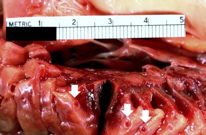 This is a gross photograph of thrombosed coronary artery (arrows).