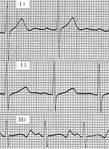 File:Electrocardiograms (ECG) from members of a family with LQTS.gif