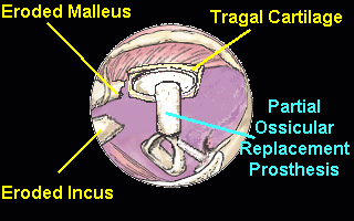 When both the incus and malleus are eroded or absent, the ossicular chain is reconstructed with a partial ossicular replacement prosthesis (PORP)[11].