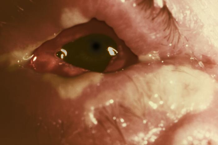 Right eye of the same 80 year-old female patient who's been accidentally infected by her grandchild, who’d been vaccinated not long before. Note the severe distortion of the palpebral margins due to the typical vaccinial lesion of the outer canthus.Adapted from Public Health Image Library (PHIL), Centers for Disease Control and Prevention.[14]