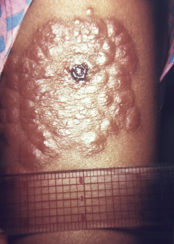 Left upper arm of a middle-aged woman who’d received a primary smallpox vaccination, and thereafter, developed local erythema, and a “bull’s eye” surrounding the site. This type of “local involvement is common in older, primary vaccines.Adapted from Public Health Image Library (PHIL), Centers for Disease Control and Prevention.[3]