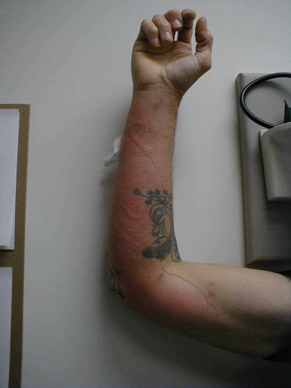 Lymphangitis of the Arm