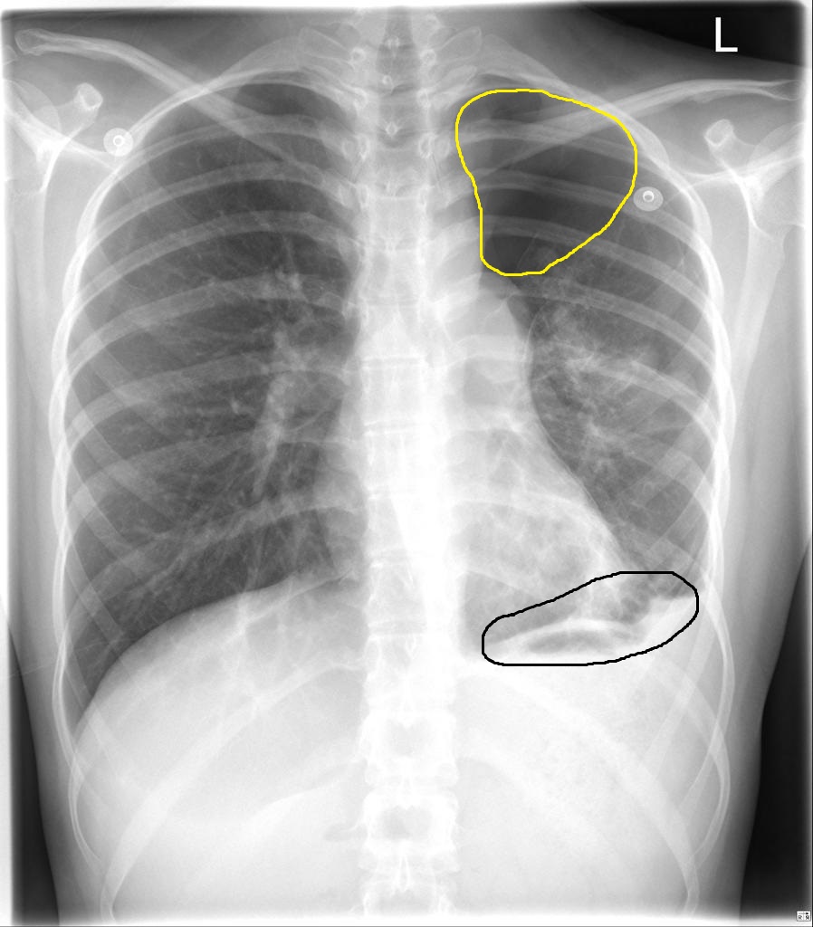 File:Catamenial-pneumothorax-2.jpg