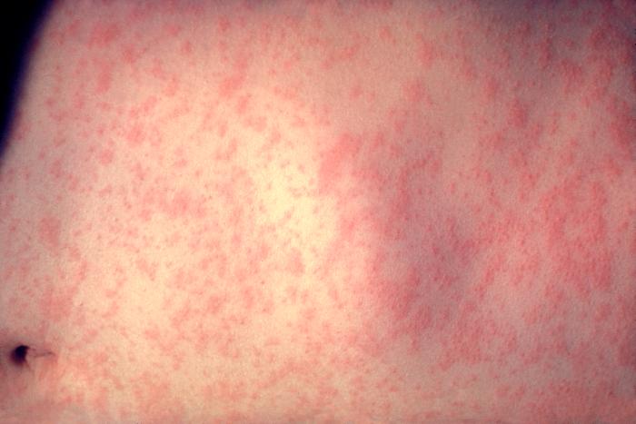 Image showing measles rash on day 3.