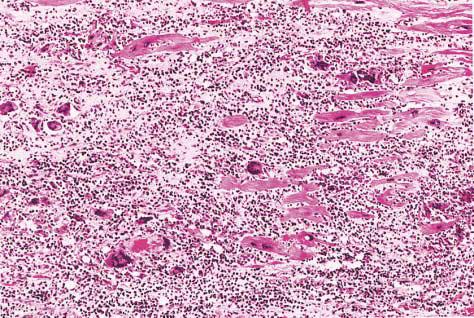 Diffuse geographic myocardial necrosis at low-power magnification. Numerous giant cells (arrows) can be identified within the inflammatory infiltrate (hematoxylin and eosin, x100)