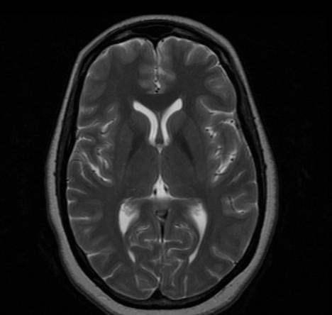 File:Normal-brain-MRI-007.jpg