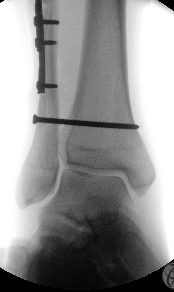 Screw-plate stabilization of the fibular fracture and trans-syndesmotic screw stabilizing the ankle mortise.